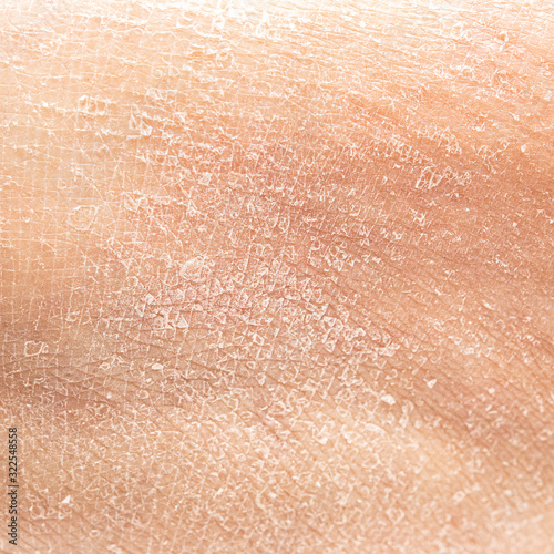 Dry human skin of a woman leg. Concept of skin rehydration cosmetics to keep the skin young photo