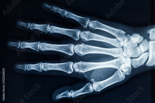 Human adult female right hand bones x-ray image. Medical and anatomy radiography or imagery. photo