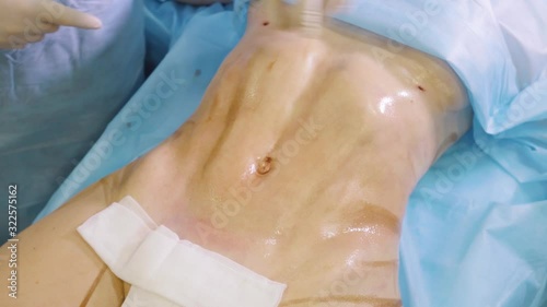 The surgeon shows the result of an operation to remove fat on the abdomen. Liposuction, lipomodeling
