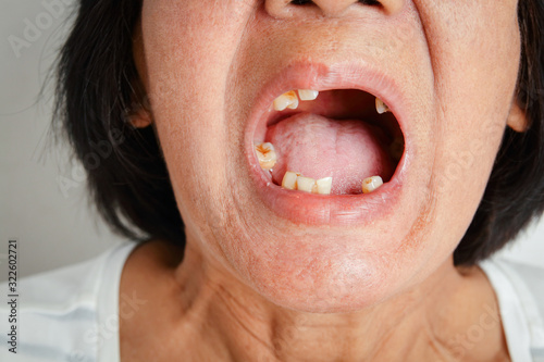 An elderly Asian woman smiled and saw the remaining teeth in the mouth. Due to partial loss resulting in the need to wear artificial teeth. The concept of good oral health