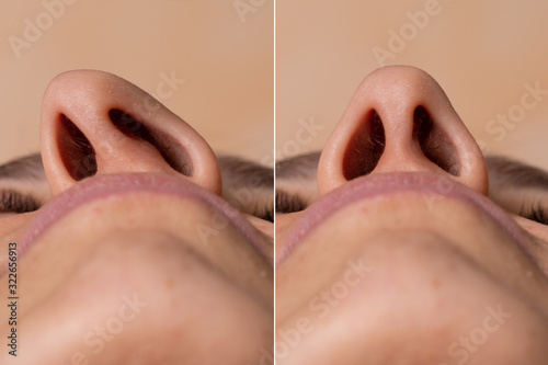 Before and after a rhinoplasty to correct the deviated nasal septum