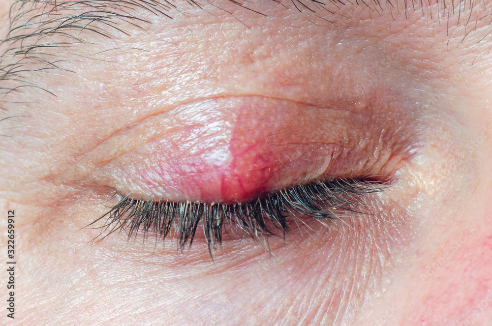 Obraz premium Chalazion on the eyelid of a man close-up