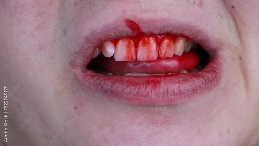 The man has blood on his teeth, severe bleeding of the gums after a blow to the jaw. Close-up of teeth after a fight or bruise