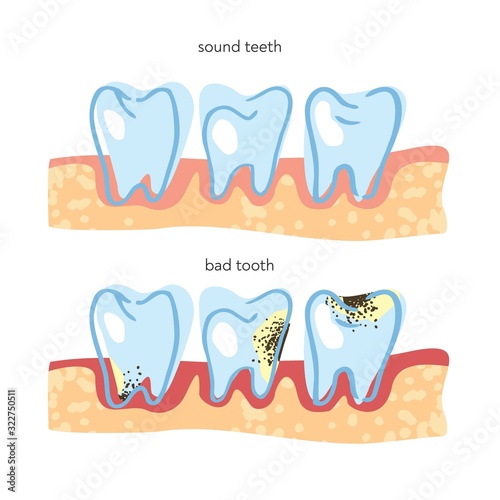 Decorative scheme of healthy and diseased teeth and gums. Banner concept about the need to care and clean teeth for pediatric dentistry clinics, training in dental hygiene. Cartoon vector illustration