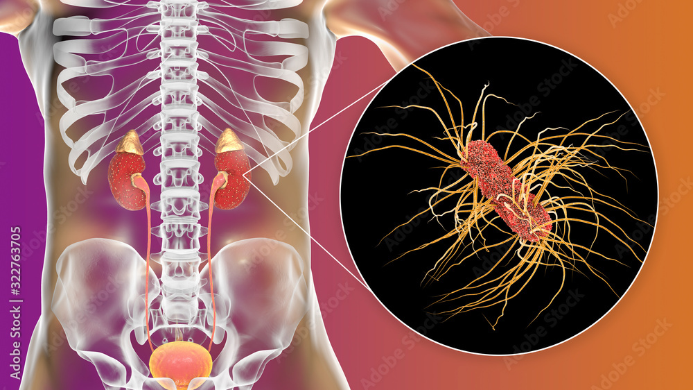 Acute pyelonephritis caused by bacteria Escherichia coli, medical ...