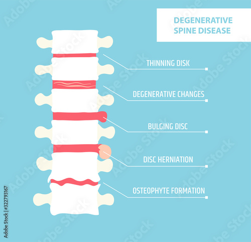 Degenerative disc disease. Spinal arthritis. Vertebral hernia
