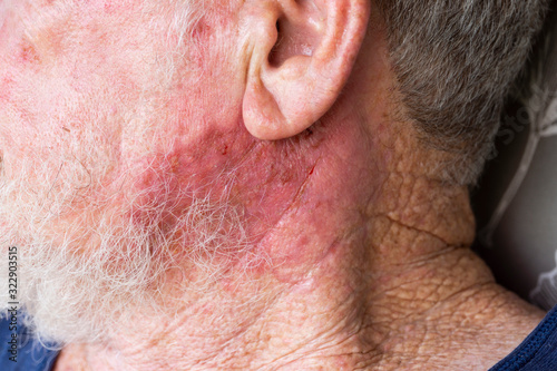 Old man with skin cancer under treatment