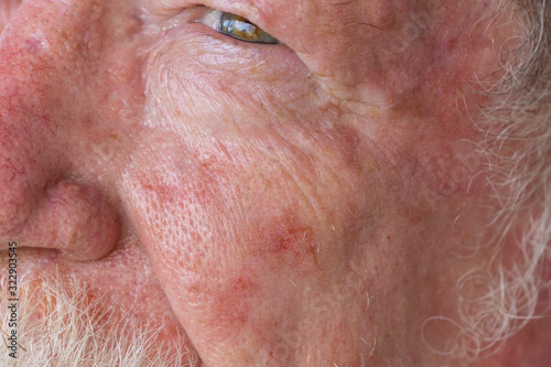 Old man needing treatment for basal cell carcinoma after an active lifetime in the sun in Queensland, Australia which has the highest rate of skin cancer. photo