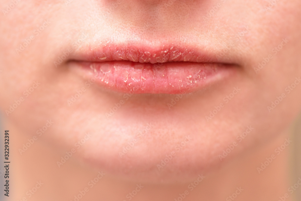 close-up of weathered female lips with dry skin. Health and skin care concept. close-up of weathered female lips with dry skin. Health and skin care concept.