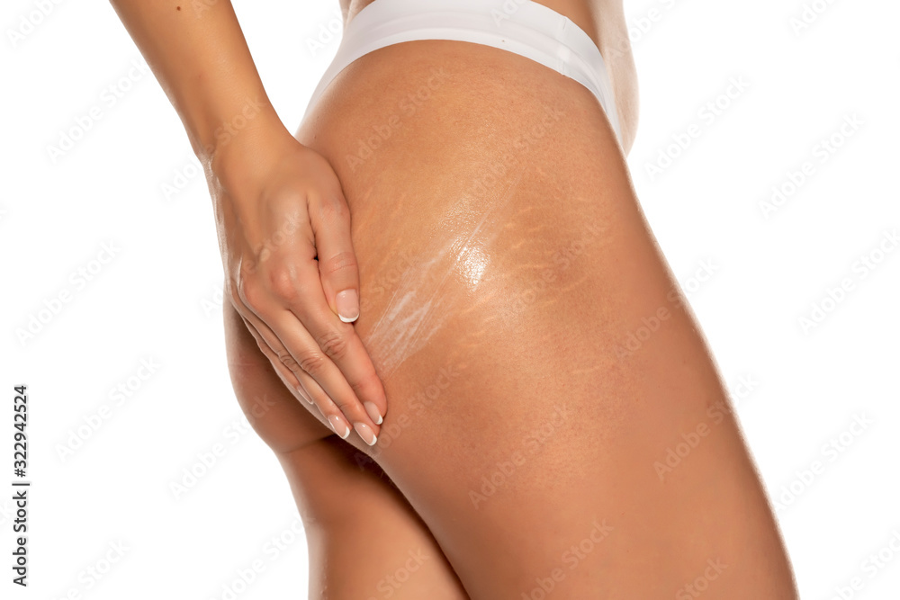 woman applying stretch marks  lotion on her bottom