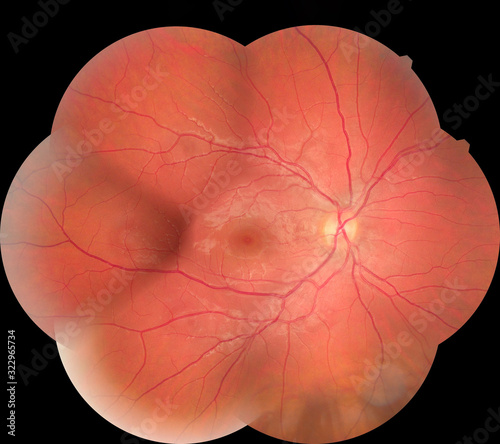 Medical photo retina diabetic retinopathy. Examination of the eye, diabetic retinopathy, ARMD photo