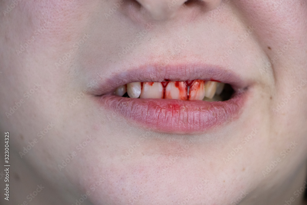The man has blood on his teeth, severe bleeding of the gums after a blow to the jaw. Closeup of