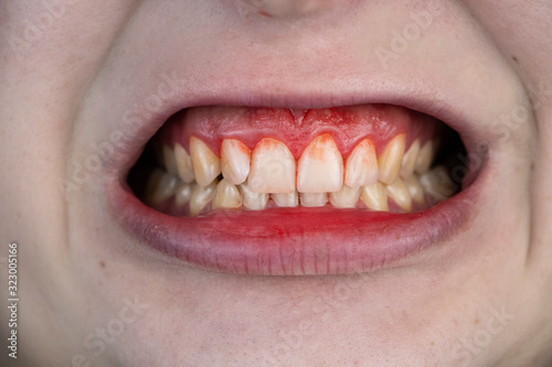 Gum bleeding and inflammation close up. A man examined by a dentist. The diagnosis of gingivitis