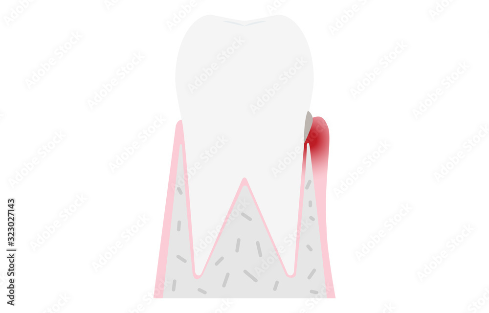 歯周病の進行段階別イラスト 歯肉炎 Stock Vector Adobe Stock