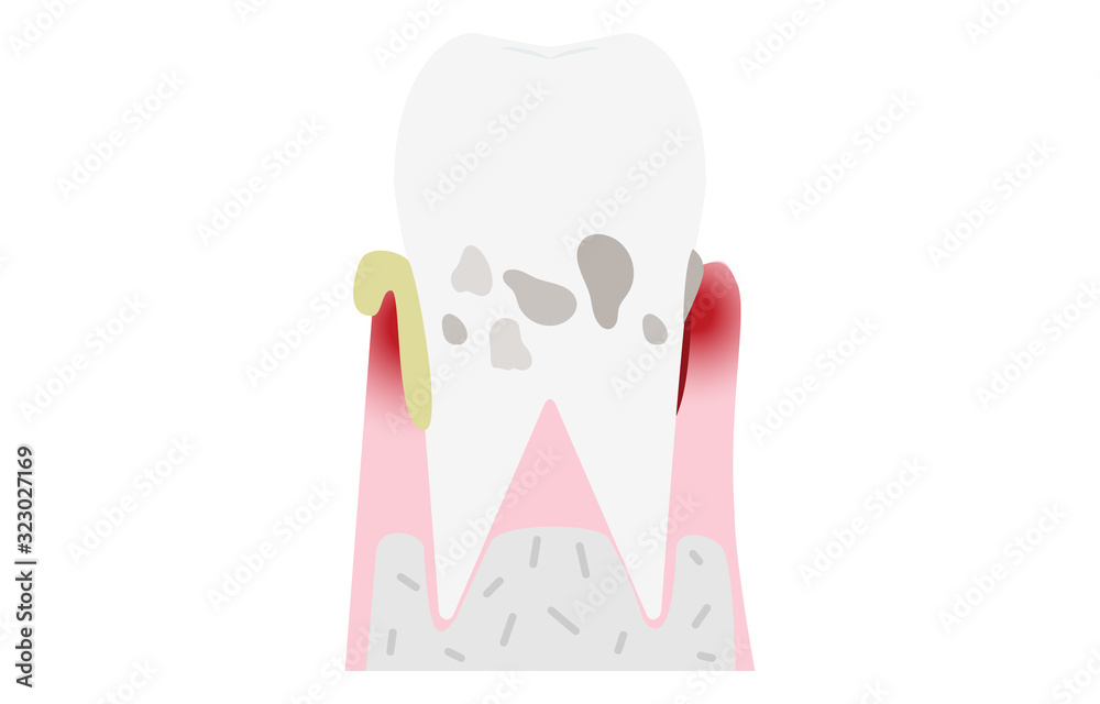 歯周病の進行段階別イラスト:重度歯周炎 Stock Vector | Adobe Stock