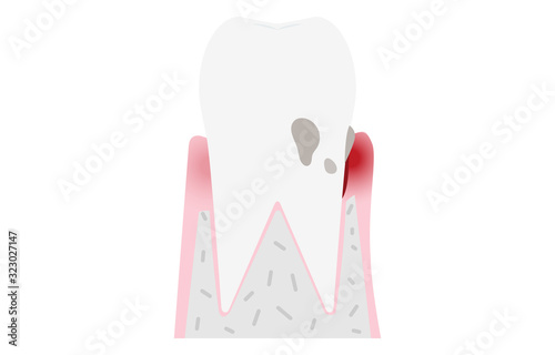 歯周病の進行段階別イラスト：初期歯周炎