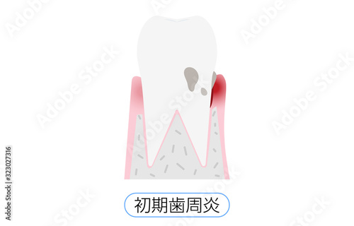 歯周病の進行段階別イラスト：初期歯周炎