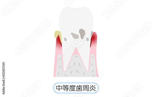 歯周病の進行段階別イラスト：中等度歯周炎