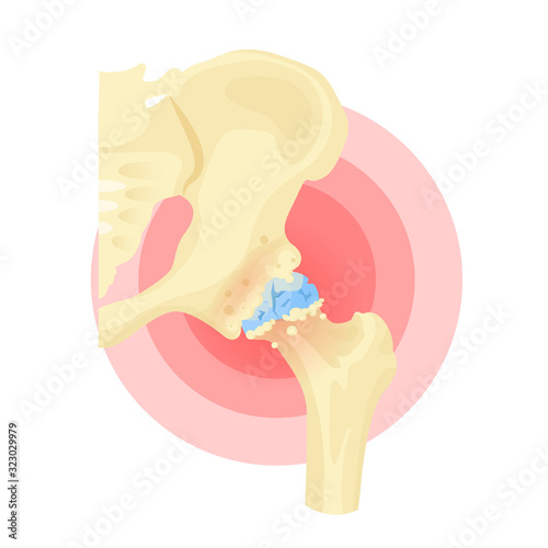 Rheumatoid arthritis diagnosis, medical therapy of body ache