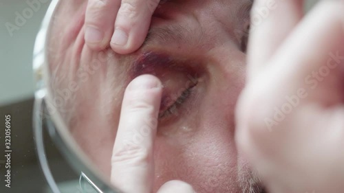 Upset white man smears bruises above his eye. Extreme Close-up soft focus