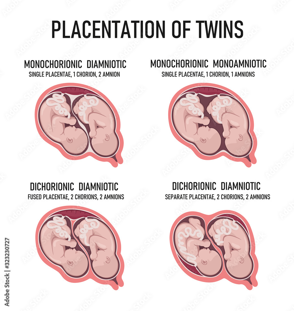 Fotografie Twin Types. Monozygotic vs Dizygotic Twins - Difference