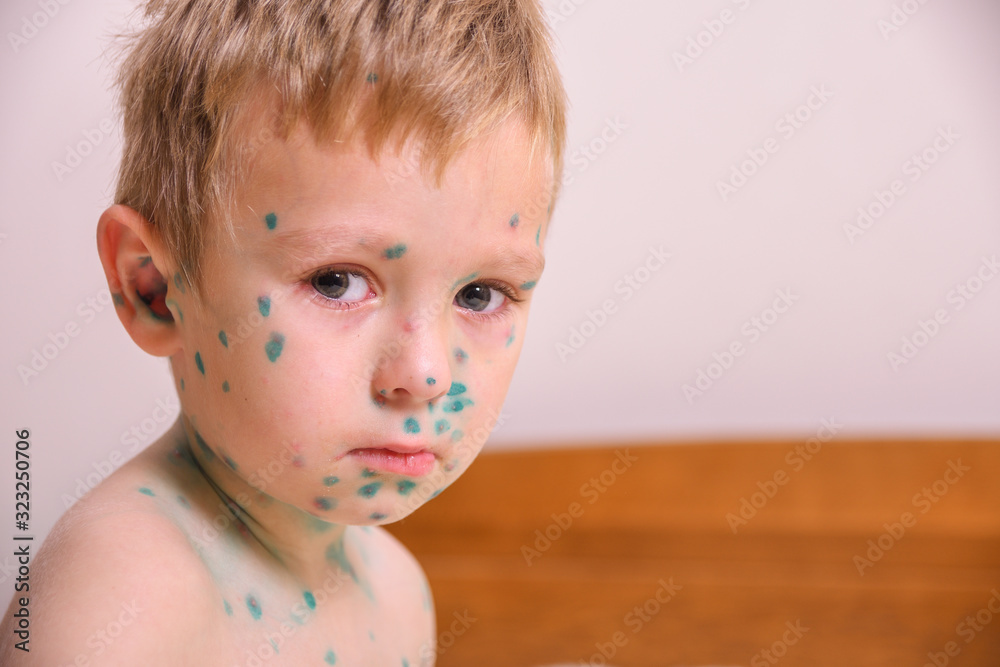Young toddler,boy with chickenpox. Sick child with chickenpox
