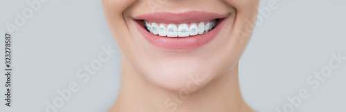 Perfect female smile, teeth after orthodontic treatment by dentist. Adult braces close-up photo