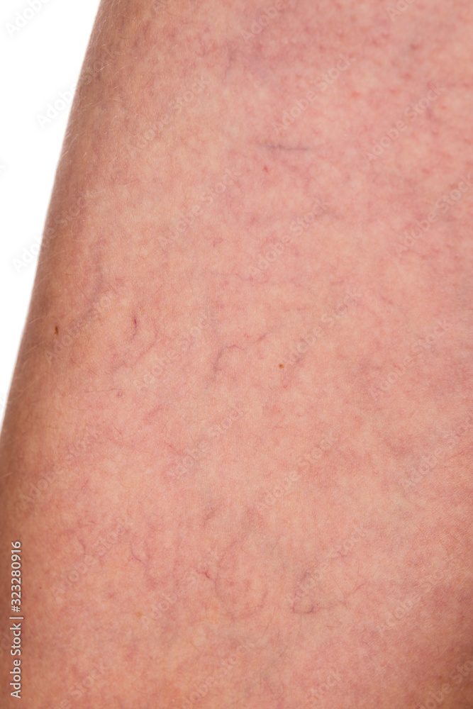 Varicose veins under the skin of a woman on a white background Varicose veins under the skin of a woman on a white background