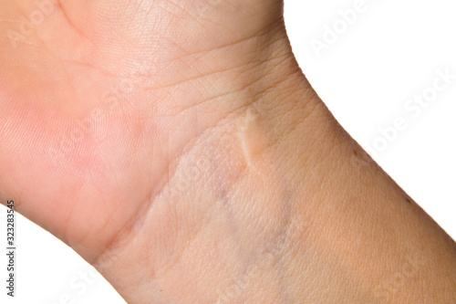 Scar on the wrist after surgery on a white background
