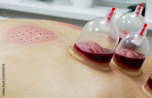 Hijama - the treatment of bloodletting. Attached vacuum cup. Blood fills in the cup.