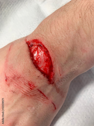 Injury from a cut on the wrist and hand requiring stitches in the Emergency room