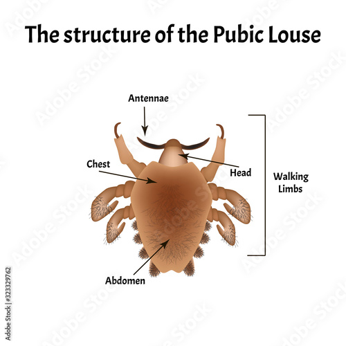 Parasitic diseases of Phthiriasis. Pediculosis pubis. Pubic lice structure. Sexually transmitted diseases. Infographics. Vector illustration on isolated background.