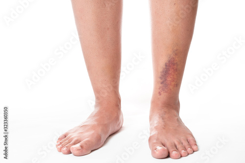Asian women have bruise on leg from accident on white background. © Chanintorn.v