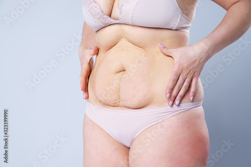 Tummy tuck, flabby skin on a fat belly, plastic surgery concept