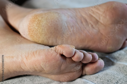 Feet of a patient with diabetes. Diabetic foot. Hyperkeratosis and cracks in the skin of the foot. Close-up. © zhannaz