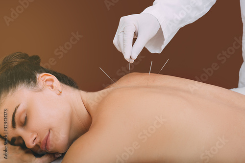 Acupunturist hand with acupuncture needle. Acupuncture treatment of chronic back pain of a woman photo