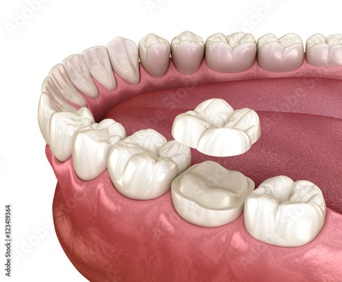 Schilderij op canvas Onlay ceramic crown fixation over molar tooth