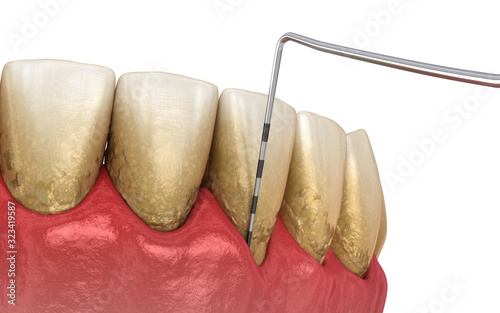 Periodontitis testing, gum recession process. Medically accurate 3D illustration photo