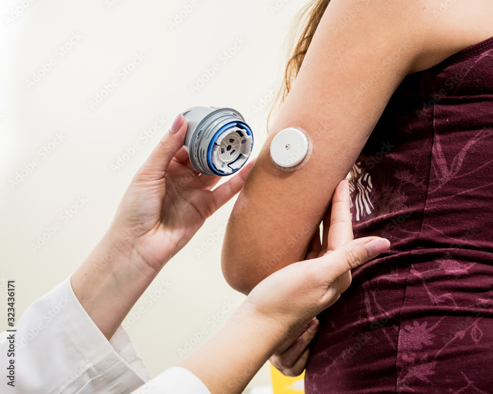 Fototapeta premium Medical device for glucose check. Continuous glucose monitoring pod. 
