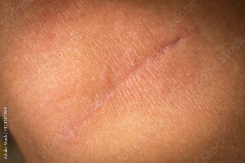 Suture after surgery on the human neck. The scar after the surgery. Close up.
