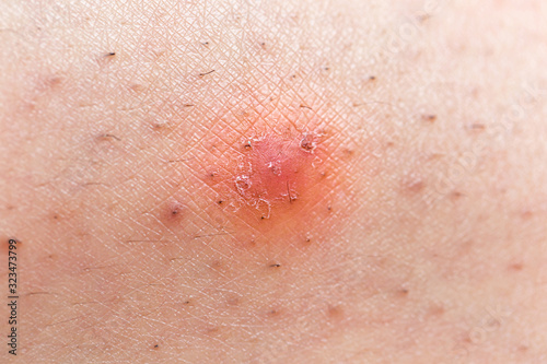 Tableau sur toile Closeup of caucasian skin with ingrown hair