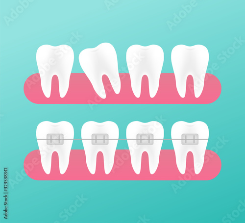 Correction of teeth with orthodontic braces. Stages of teeth alignment. Dental clinic services. Vector illustration.