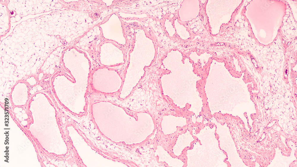 Photomicrograph of a cavernous lymphangioma (cystic hygroma) excised from the neck of a child.   These benign lesions are often present at birth and involve blockage of lymphatic system. 