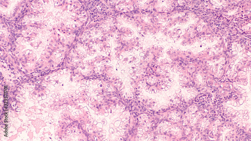 Micrograph of an endometrial curetting specimen from a patient following spontaneous abortion, showing Arias Stella reaction.  This benign proliferation may be confused with adenocarcinoma (cancer). photo