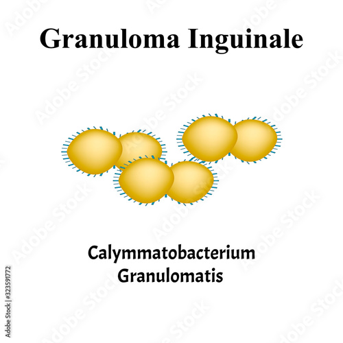 Inguinal granuloma. Bacterial infections. Sexually transmitted diseases. Infographics. Vector illustration on isolated background. photo