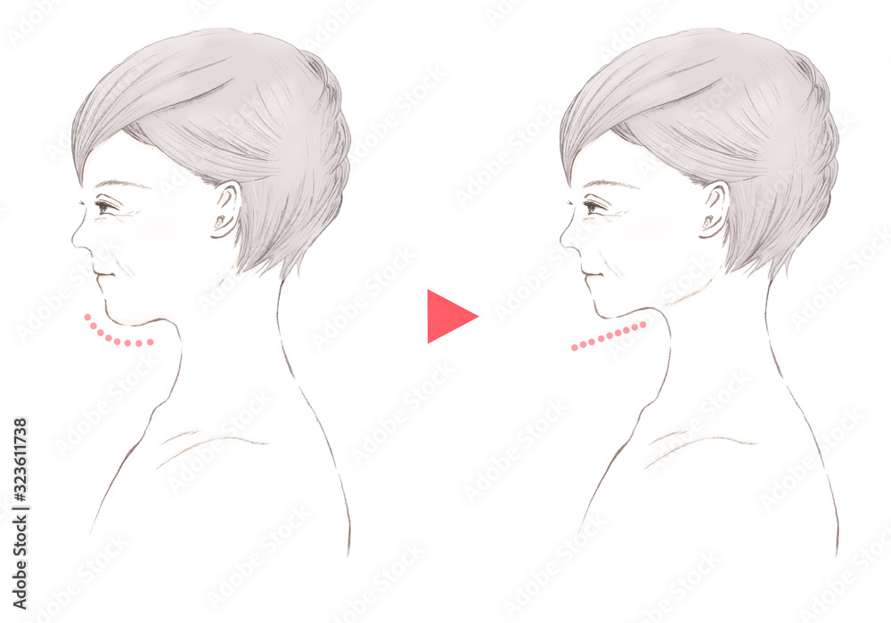 シニア女性の二重あごとたるみ ビフォーアフター シニア女性の二重あごとたるみ ビフォーアフター