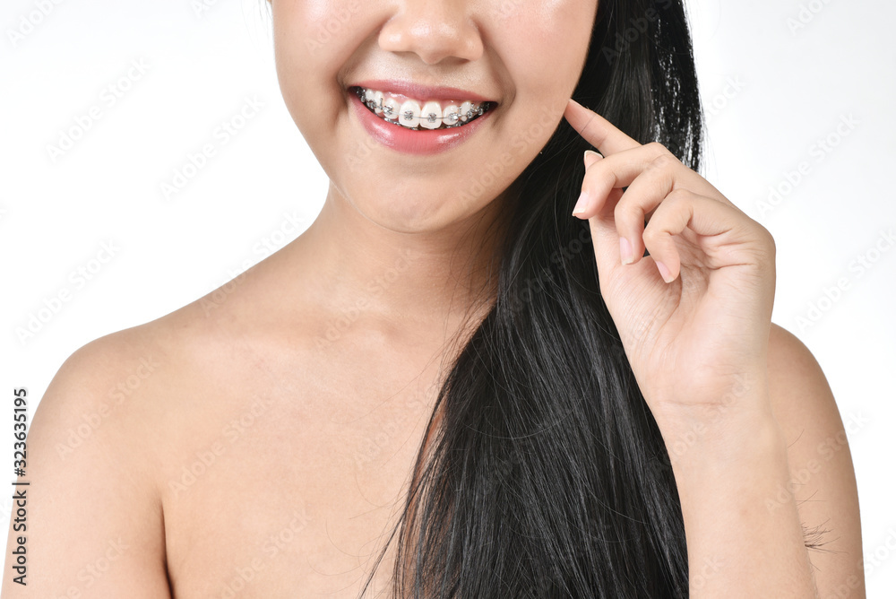 Asian woman were brace are smiling happy face in white isolated background. Dental care oral healthy concept. Asian woman were brace are smiling happy face in white isolated background. Dental care oral healthy concept.