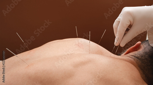 Close-up needle in the back of man during acupuncture procedure on a brown background. Acupuncture. Macro photo