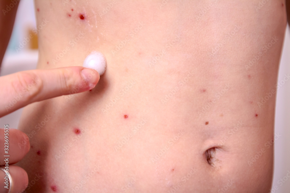 Therapy against the virus of Varicella has measles, chicken pox, rubella Therapy against the virus of Varicella has measles, chicken pox, rubella