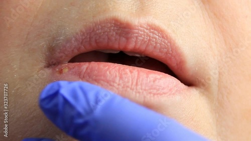 gloved doctor palpates the lips of a girl with sores from herpes, herpes. lip treatment, slow-motion shooting, copy space photo